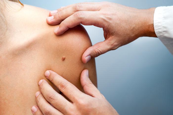 Melonama – Types, Causes, and Risk Factors