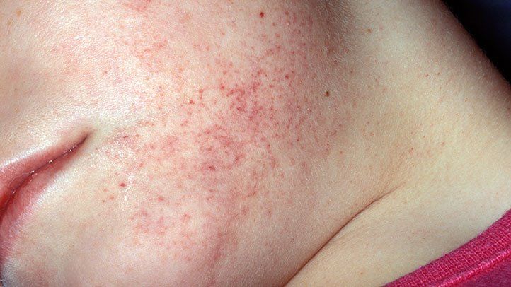 Leukemia – Its Types and Risk Factors