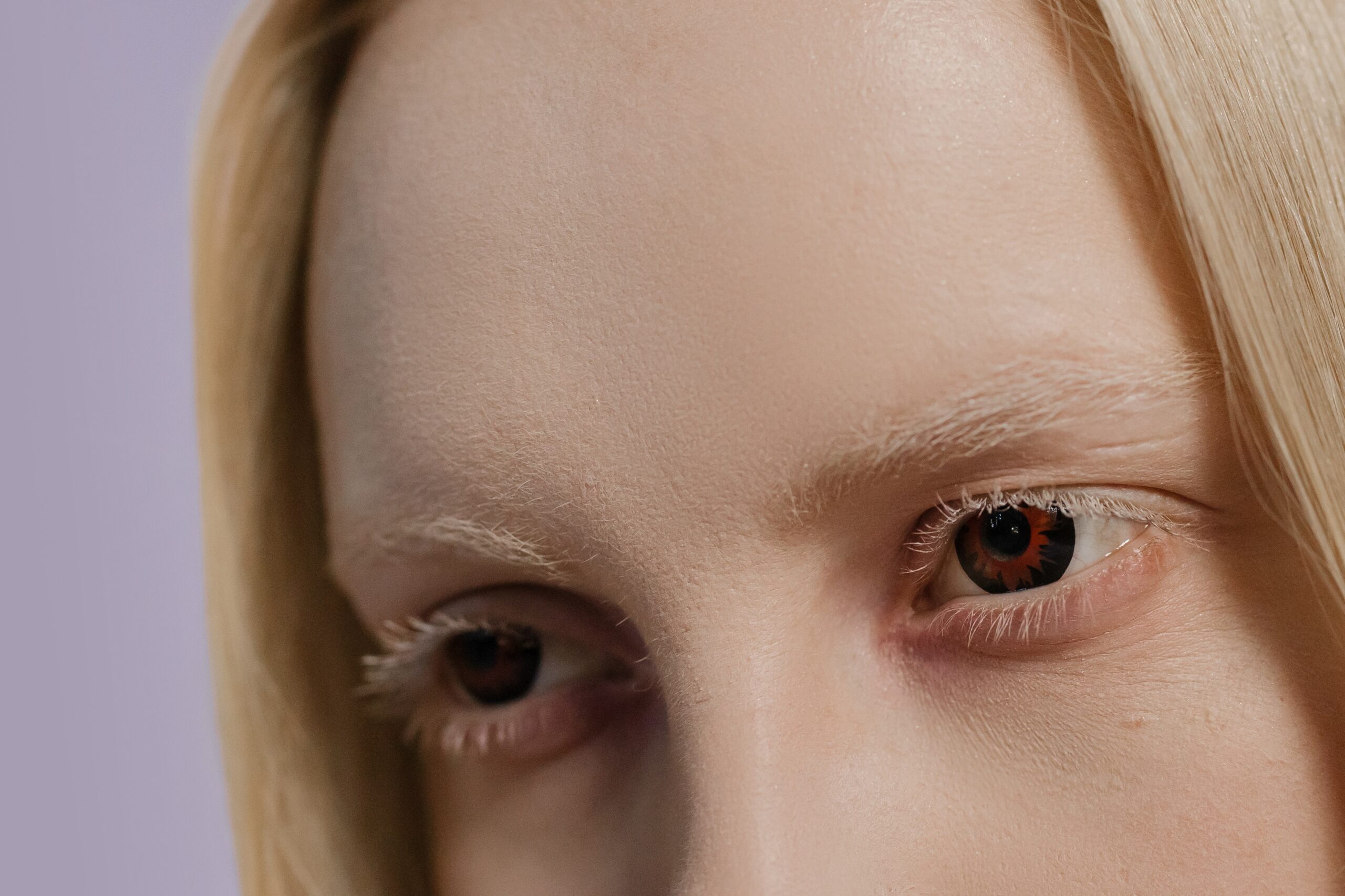 Various Causes of Dry Eyes and How to Treat It